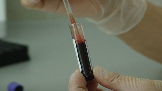 Blood tube examined by a doctor