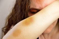 Woman covered in bruises