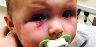 Injured baby toddler