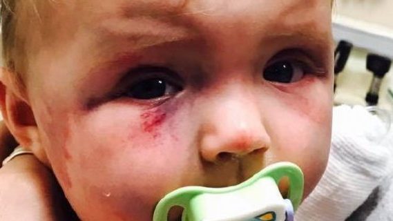 Injured baby toddler